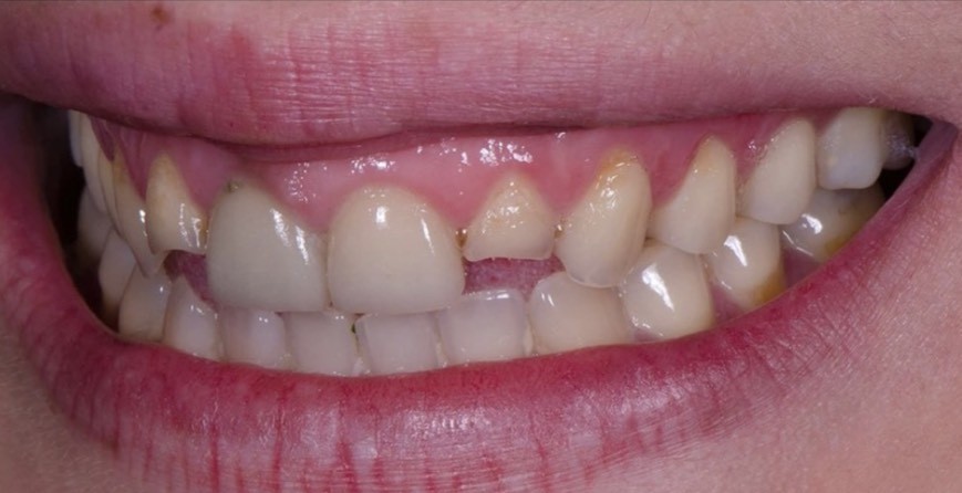 Case 01 治療前の口腔内写真